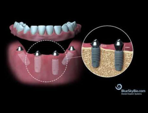 Cognitive Function and Dental Implants