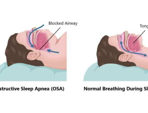 WHY MOST SLEEP APNEA TREATMENT EVENTUALLY FAILS